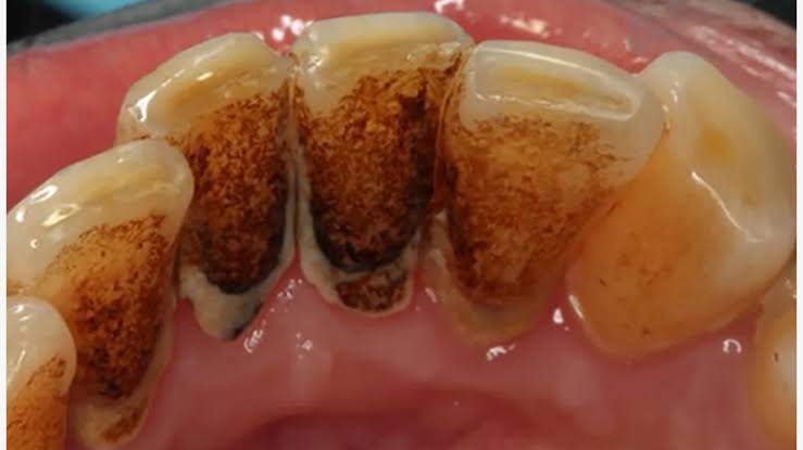 Root Canal Treatment Purnia