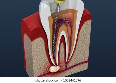 Root Canal Treatment Purnia
