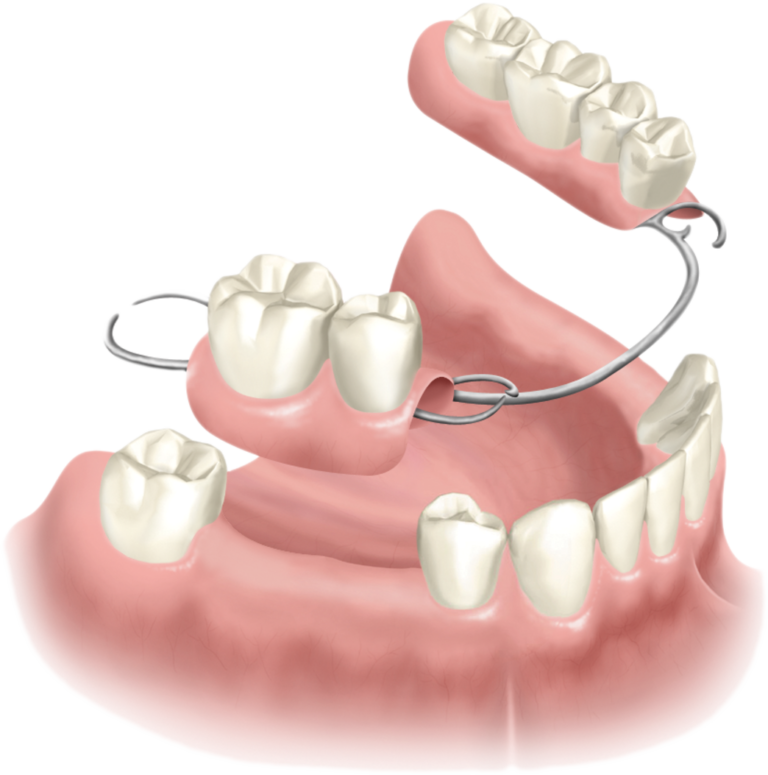REMOVEL TEETH