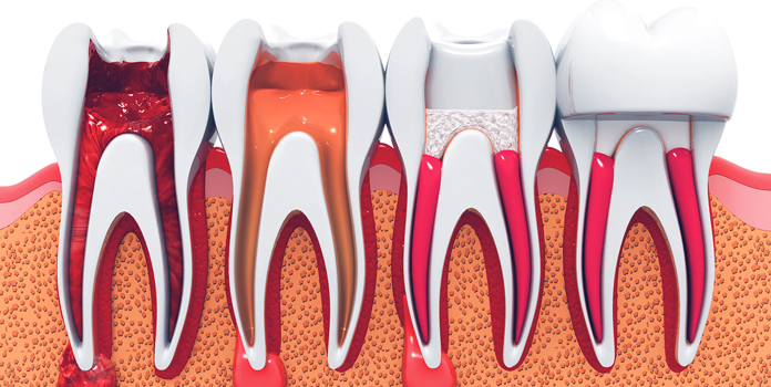 root canal treat -rctinpurnia