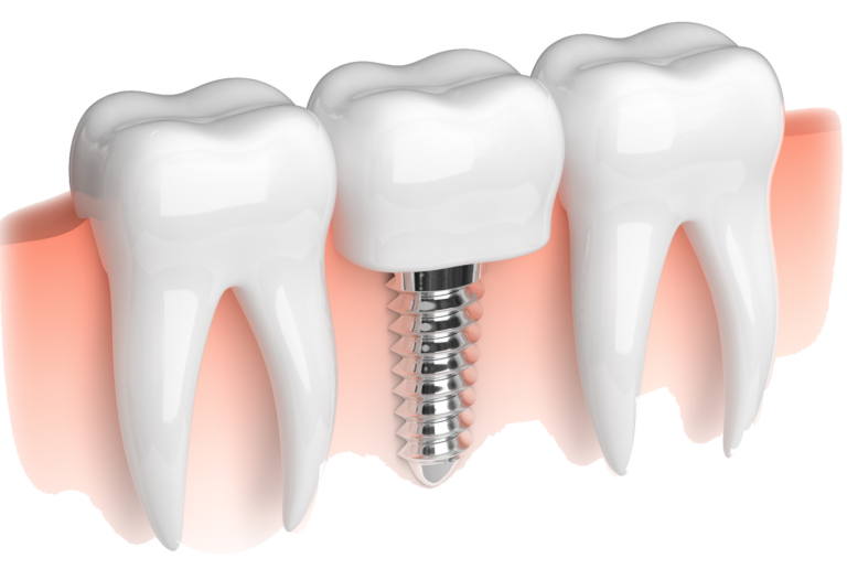 dental-implant-purnia.jpg