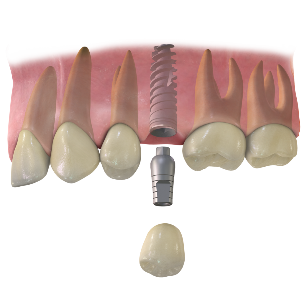 IMPLANT