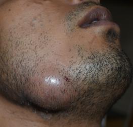 Dental-Abscess