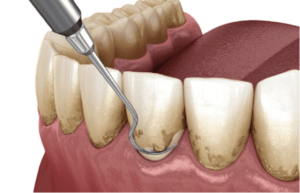 Home 3Best Dentist In Purnia TEETH CLEANING