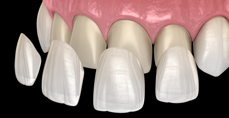Dental Veneers