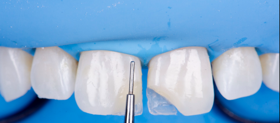 BROKEN FRONT TOOTH PURNIA