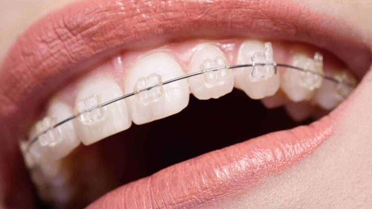 Ceramic Braces in Purnia – Tooth Colored Braces