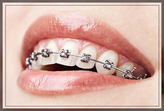 Lingual Braces purnia apex dental clinic -rctinpurnia