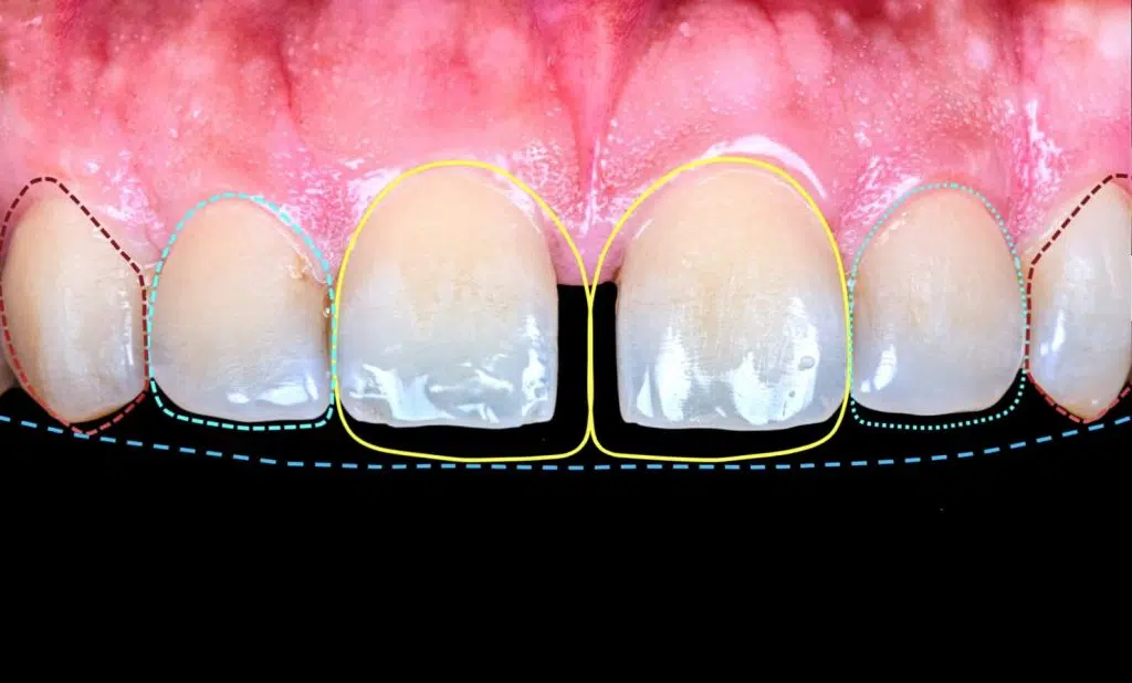 MIDLE TEETH GAP CLOSER IS PURNIA