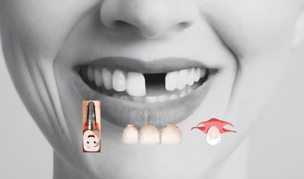 FRONT TOOTH MISSING OPERATION