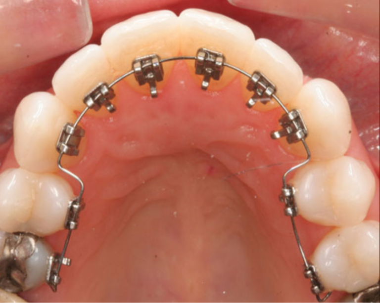 lingual braces treatment purnia