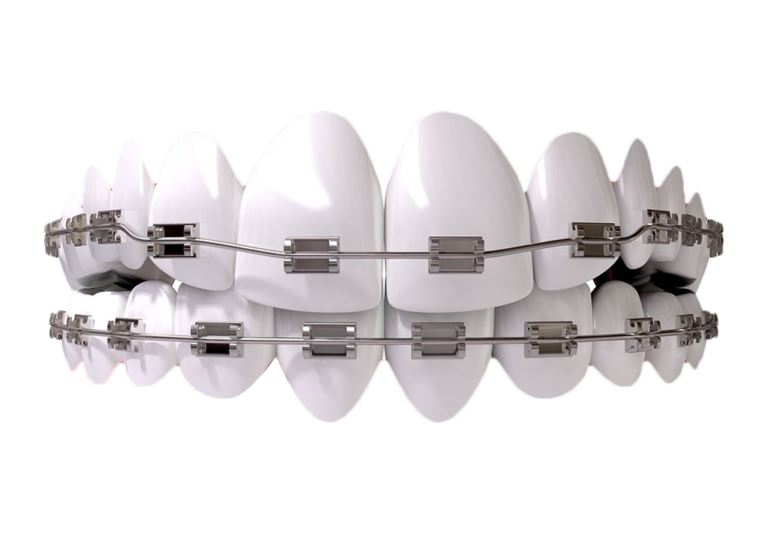 metal braces purnia