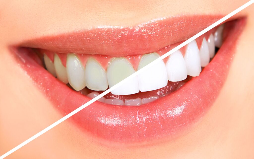 Home 7Best Dentist In Purnia teeth whitening
