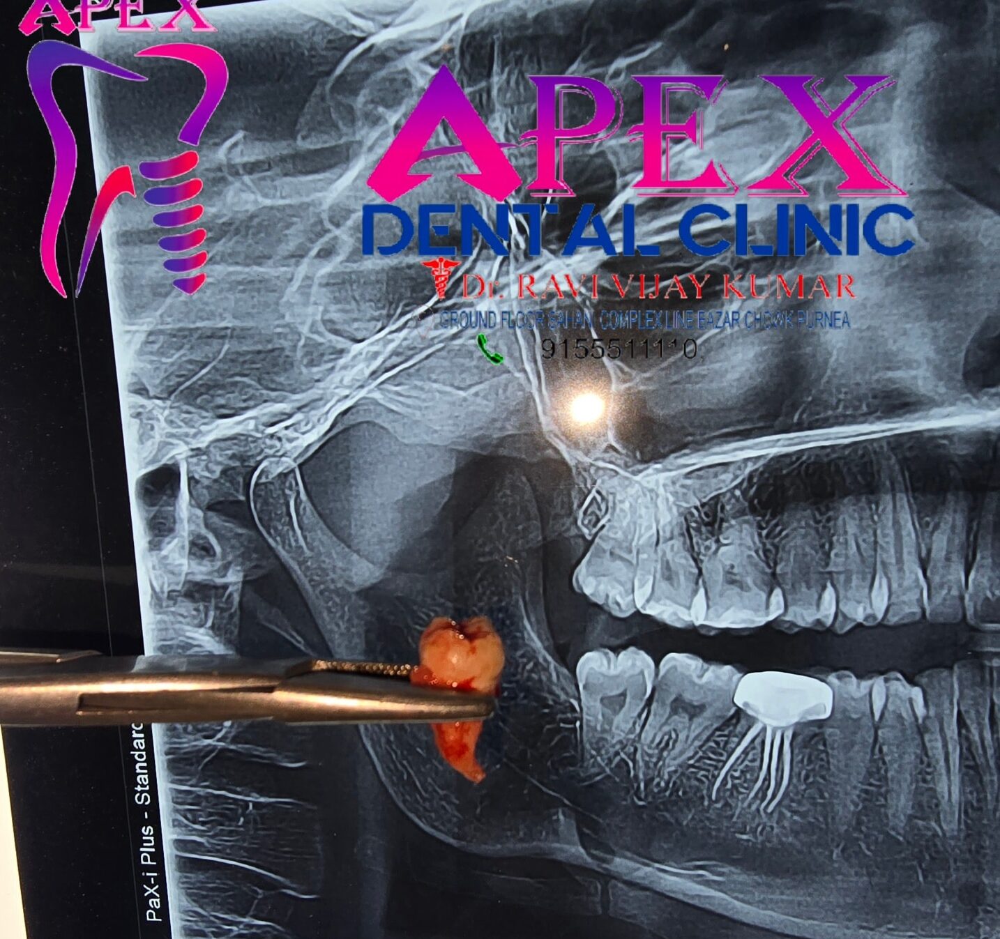 Wisdom Teeth Impaction Treatment and Safe Extraction in Purnia at Apex Dental Clinic