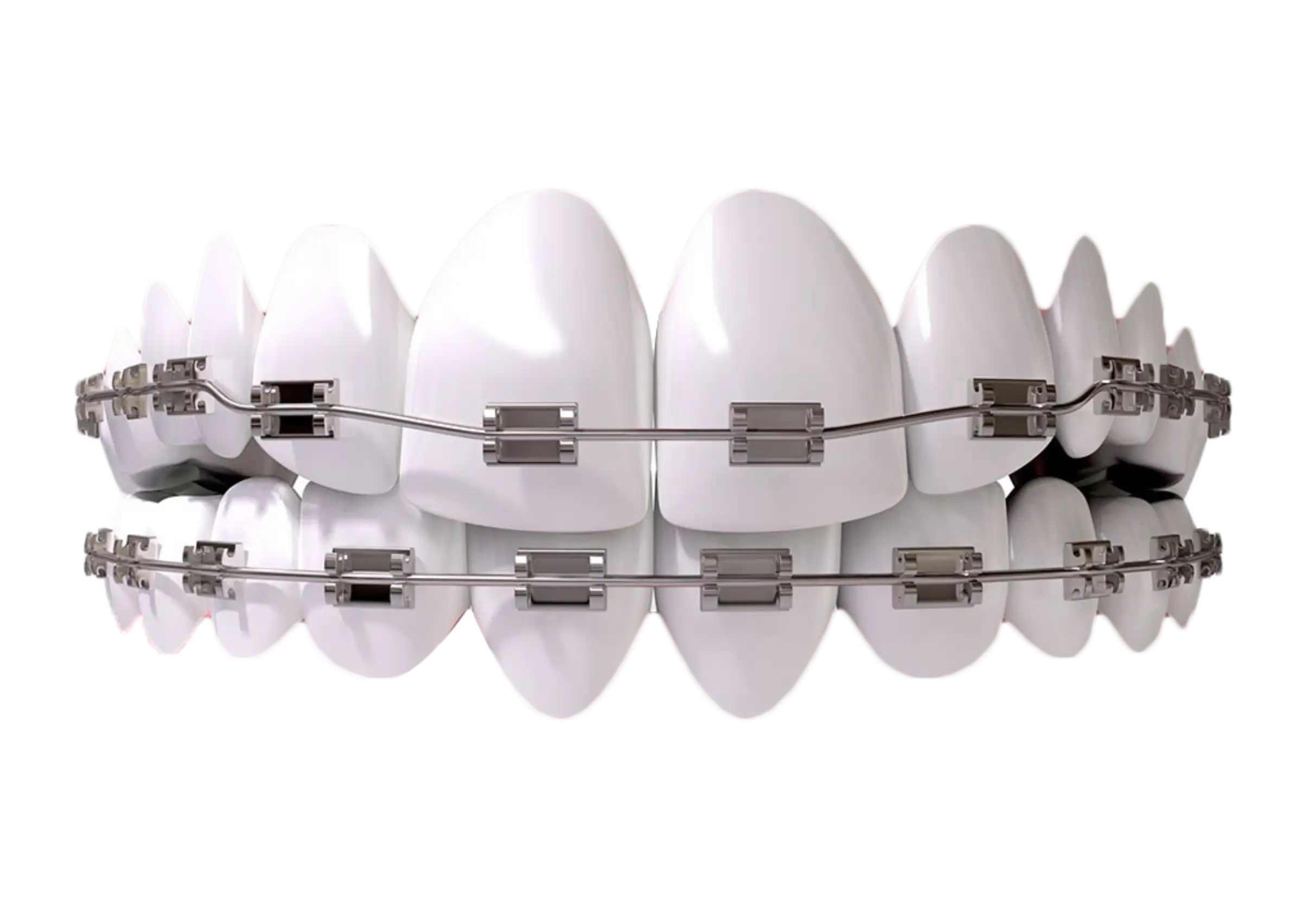 BRACES -rctinpurnia