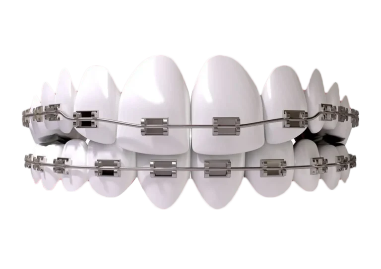 Dental Braces Treatment in Purnia – Apex Dental Clinic