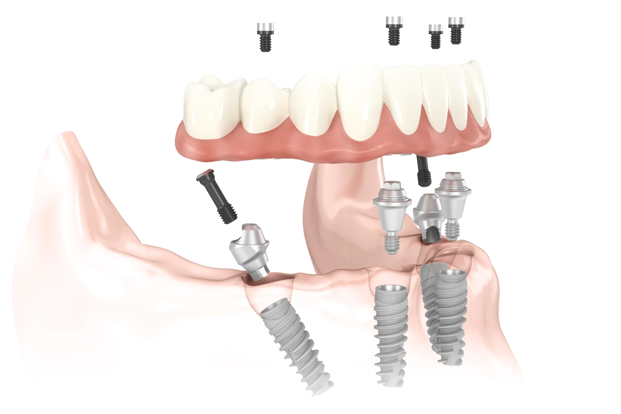 Full mouth rehabilitation with All on 4 dental implants guided surgery before and after at Line Bazar Purnia