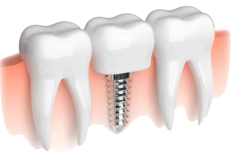 implant in purnia -rctinpurnia