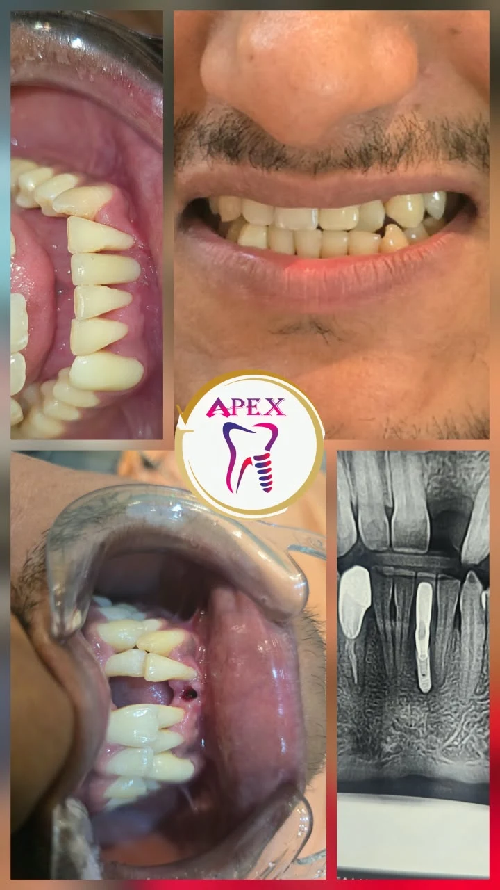 Posterior molar tooth replacement using Adin dental implant at Apex Dental Clinic Purnia
