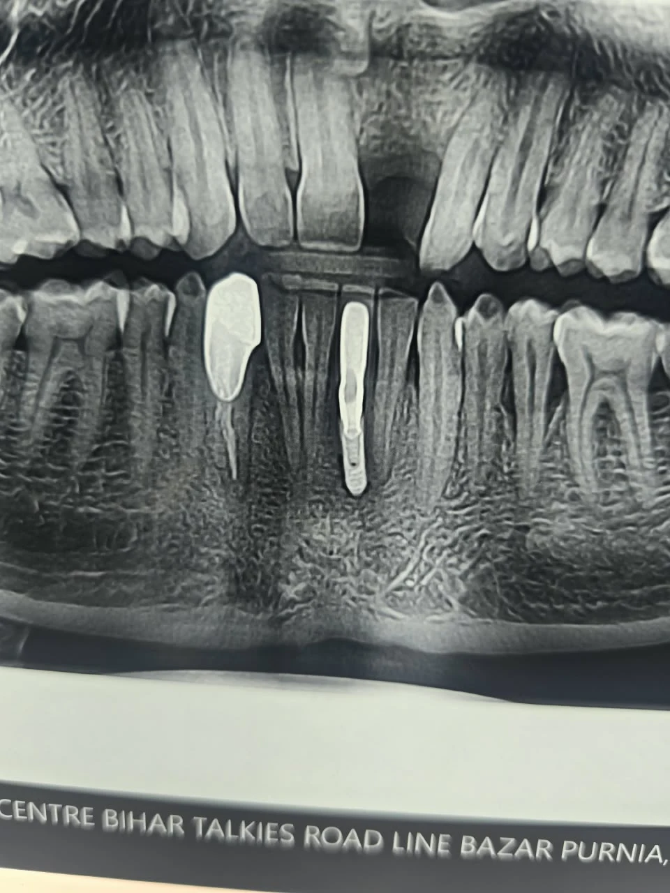 Before and after single tooth replacement using Osstem dental implant with zirconia crown at Apex Dental Clinic Purnia
