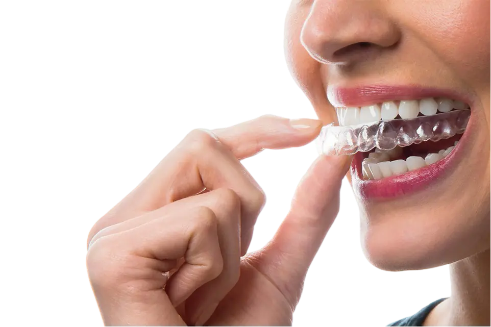 Clear Invisible Aligners in Purnia - Apex Dental Clinic