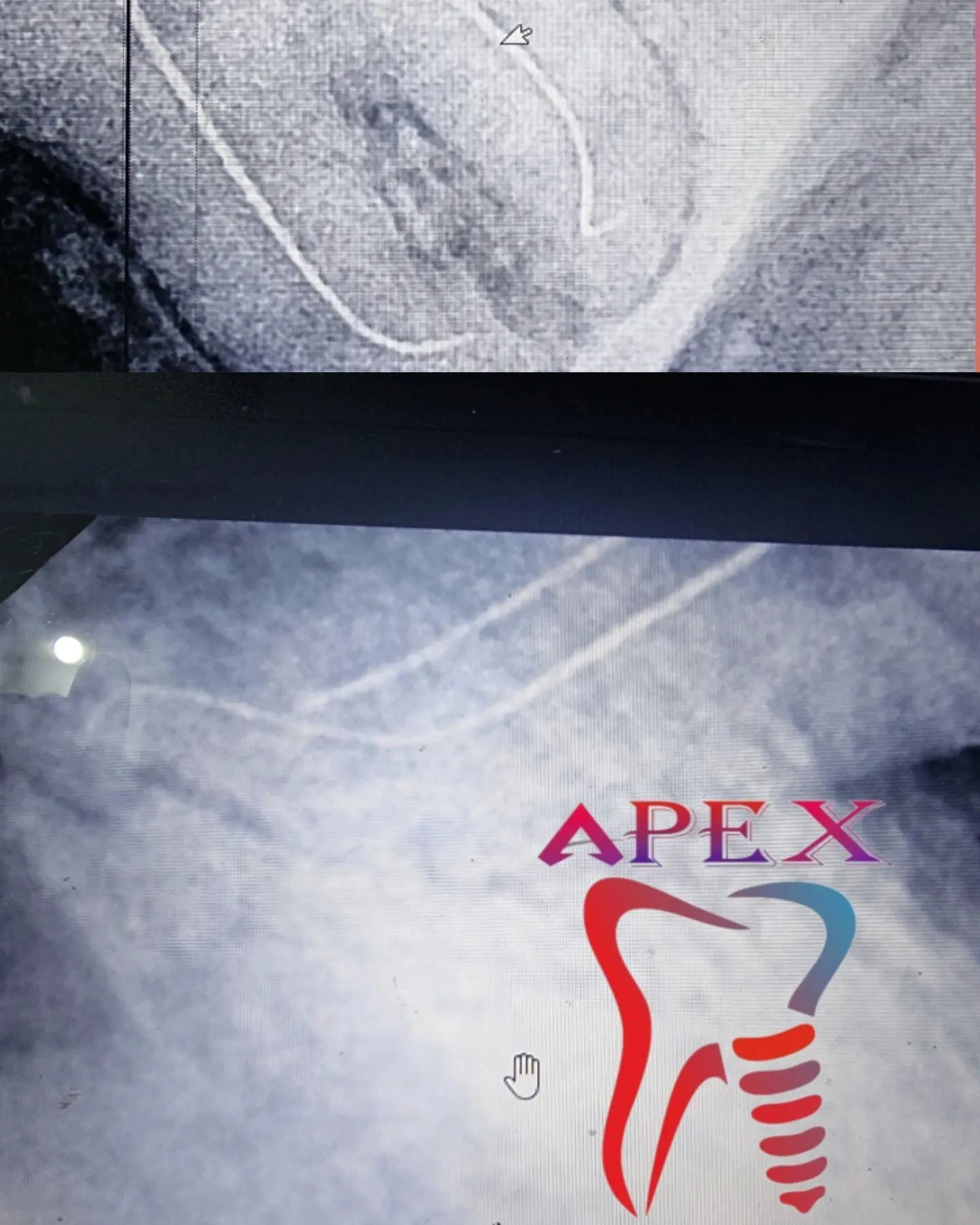 Complex Curved Root Canal Treatment