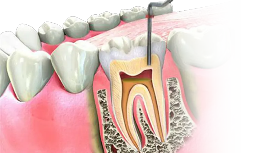 RCT in Purnea Best RCT Clinic Apex Dental