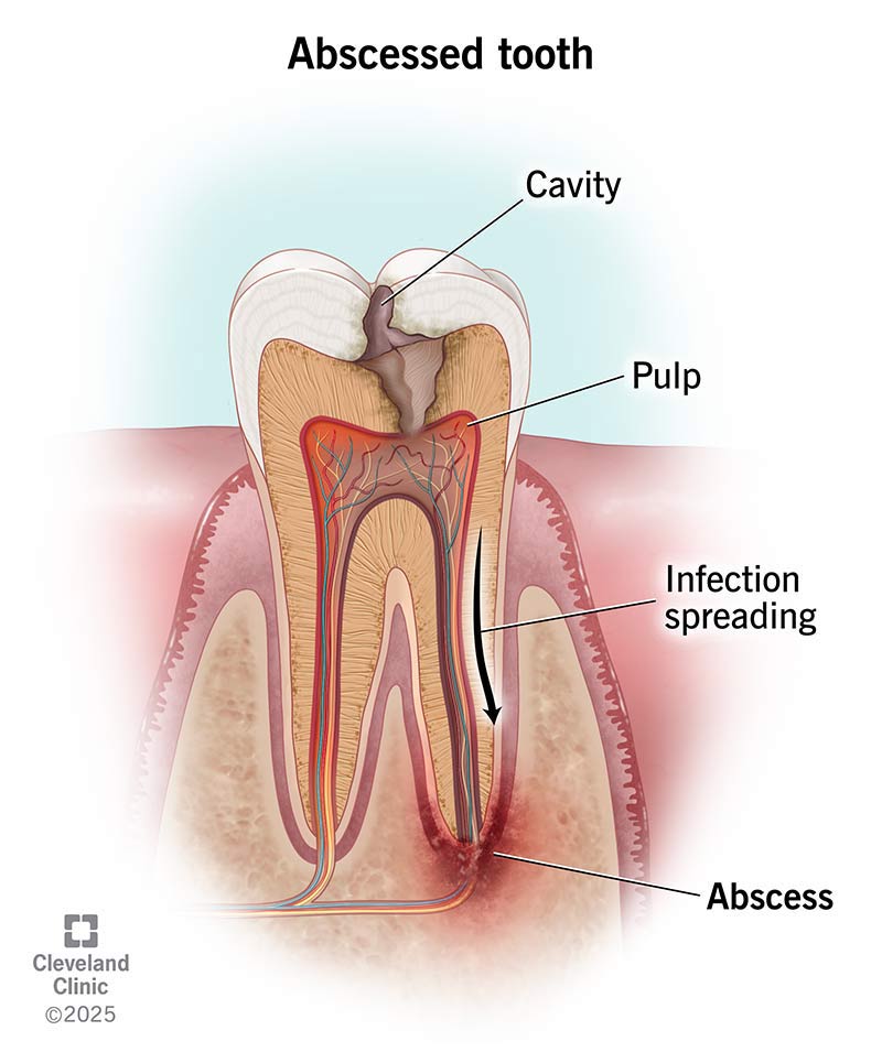 Dental abscess gum swelling pus infection spreading