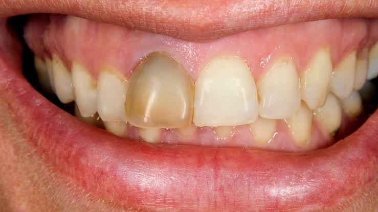Dental trauma broken tooth sports injury