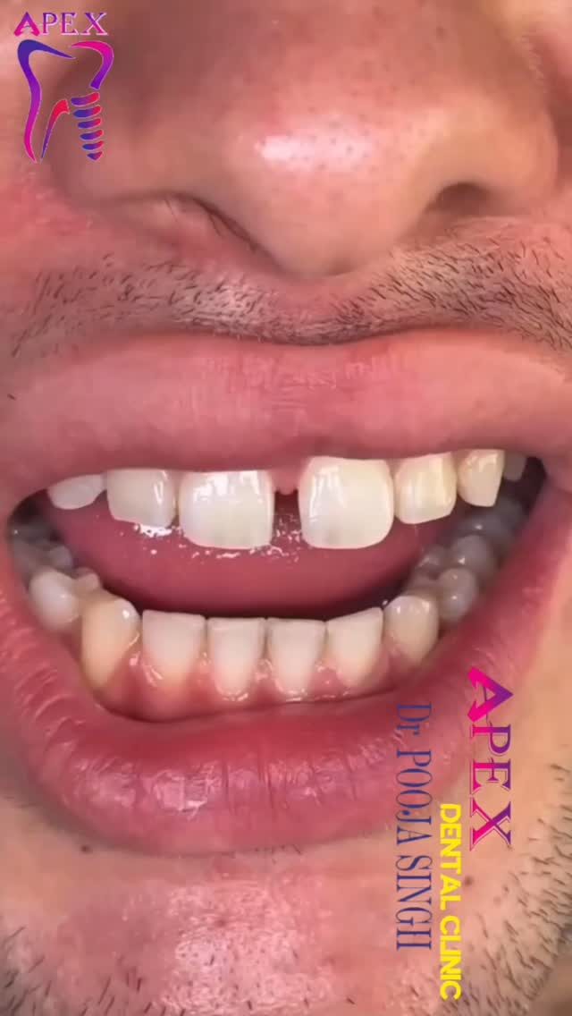 Instagram post from apexdent.in. This post is in position 5.