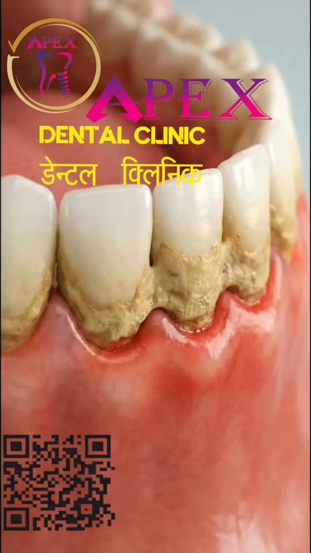 Instagram post from apexdent.in. This post is in position 7.